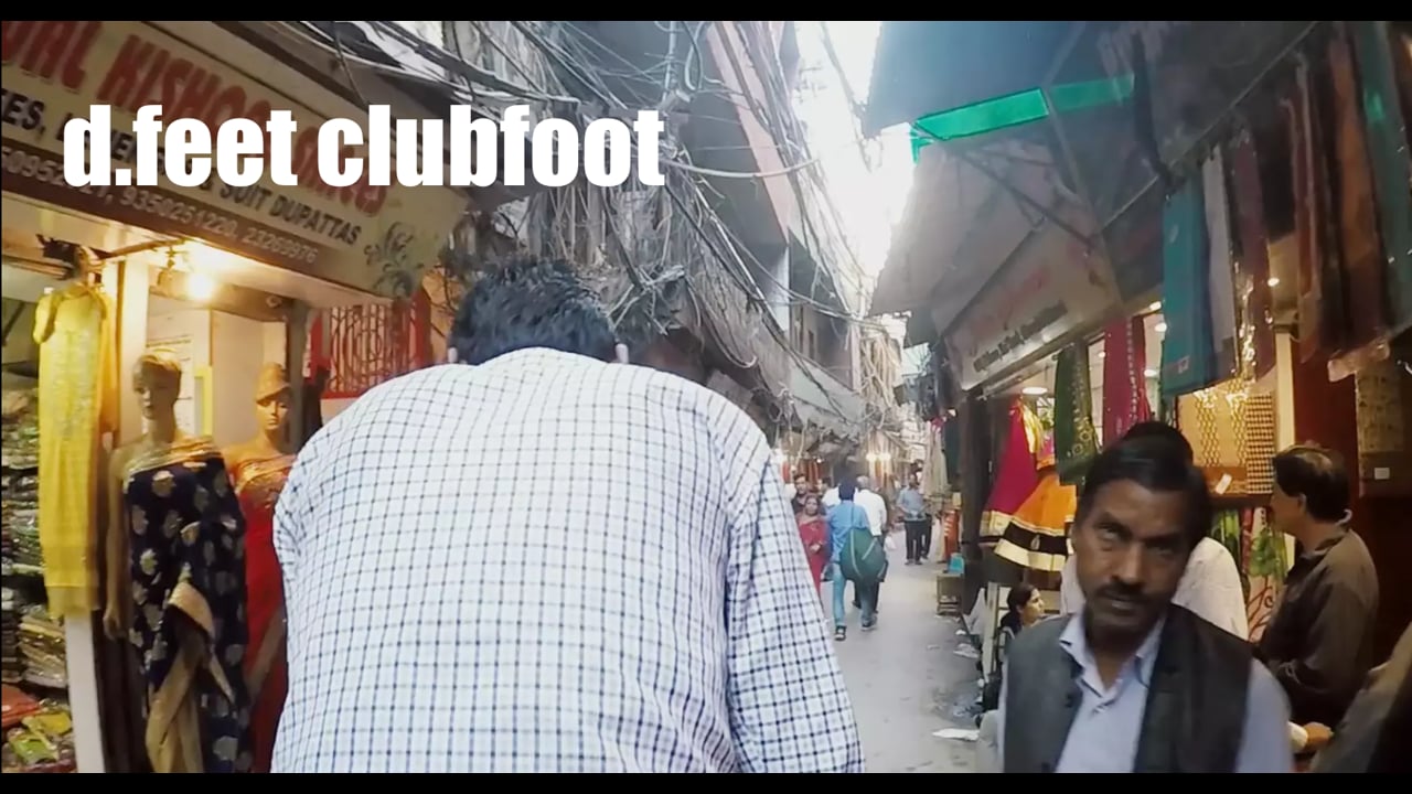 d.feet clubfoot // Social E Lab 2015