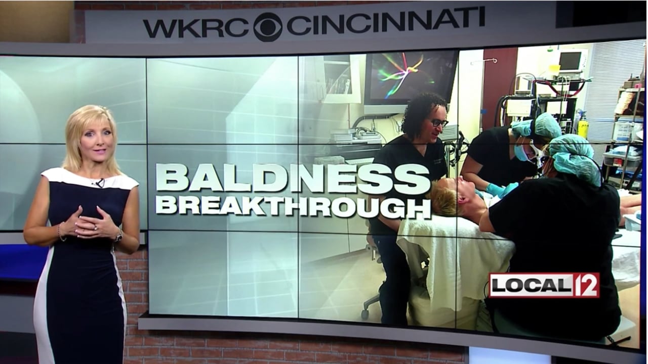 Liz Bonis shows how Follicular unto Extraction (FUE)Hair Transplants are performed with Dr. Jon Mendelsohn
