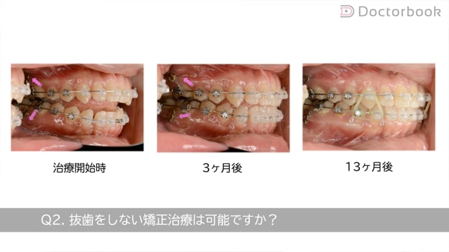 歯列矯正治療の失敗と再治療 : 臨床現場からのレポート