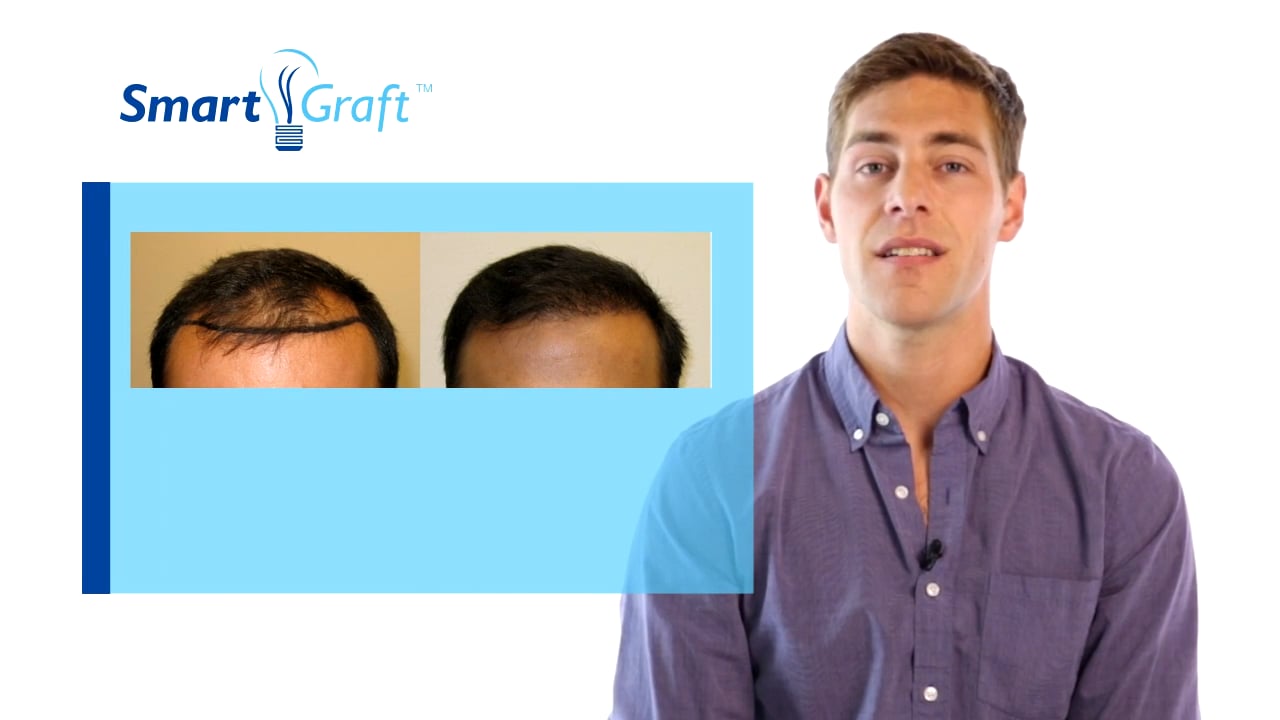New_What is FUE hair transplatation