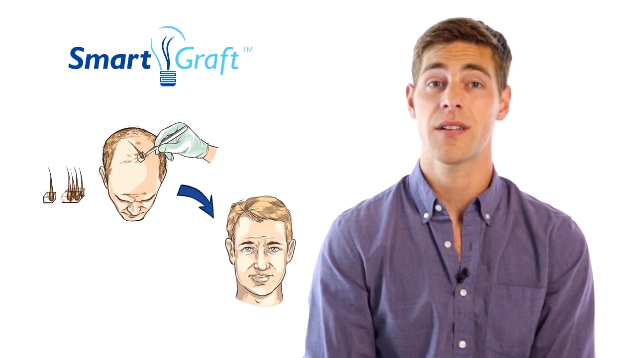 What is FUE hair transplatation