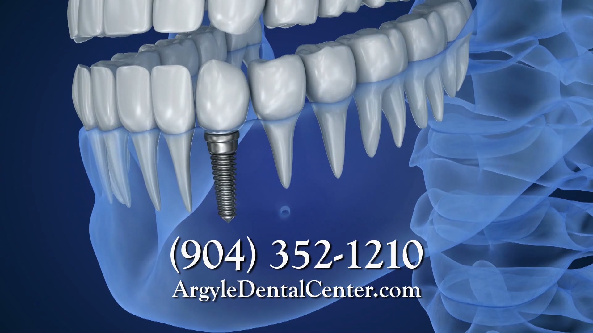 Argyle Dental Center - Implants - :30 Second Commercial