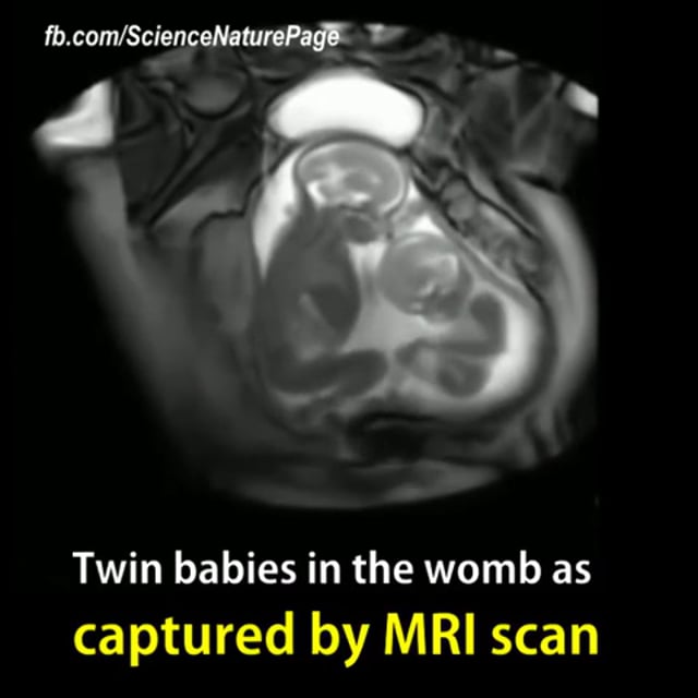 Baby and mom in MRI Scan