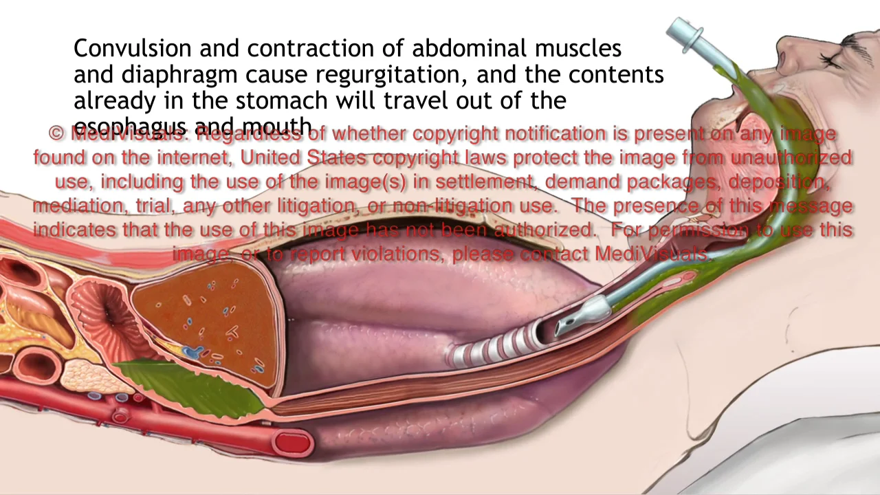 Laryngeal Mask Airway