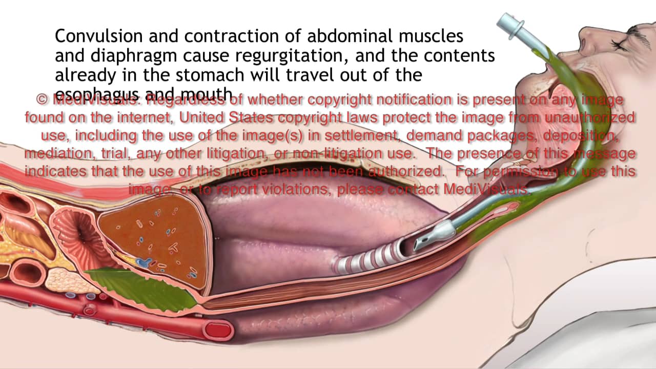 Endotracheal (ET) Intubation vs. Laryngeal Mask Airway (LMA) Resulting