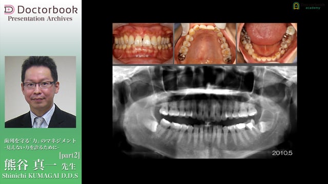 歯列を守る「力」のマネジメント ～見えない力を診るために～ #2