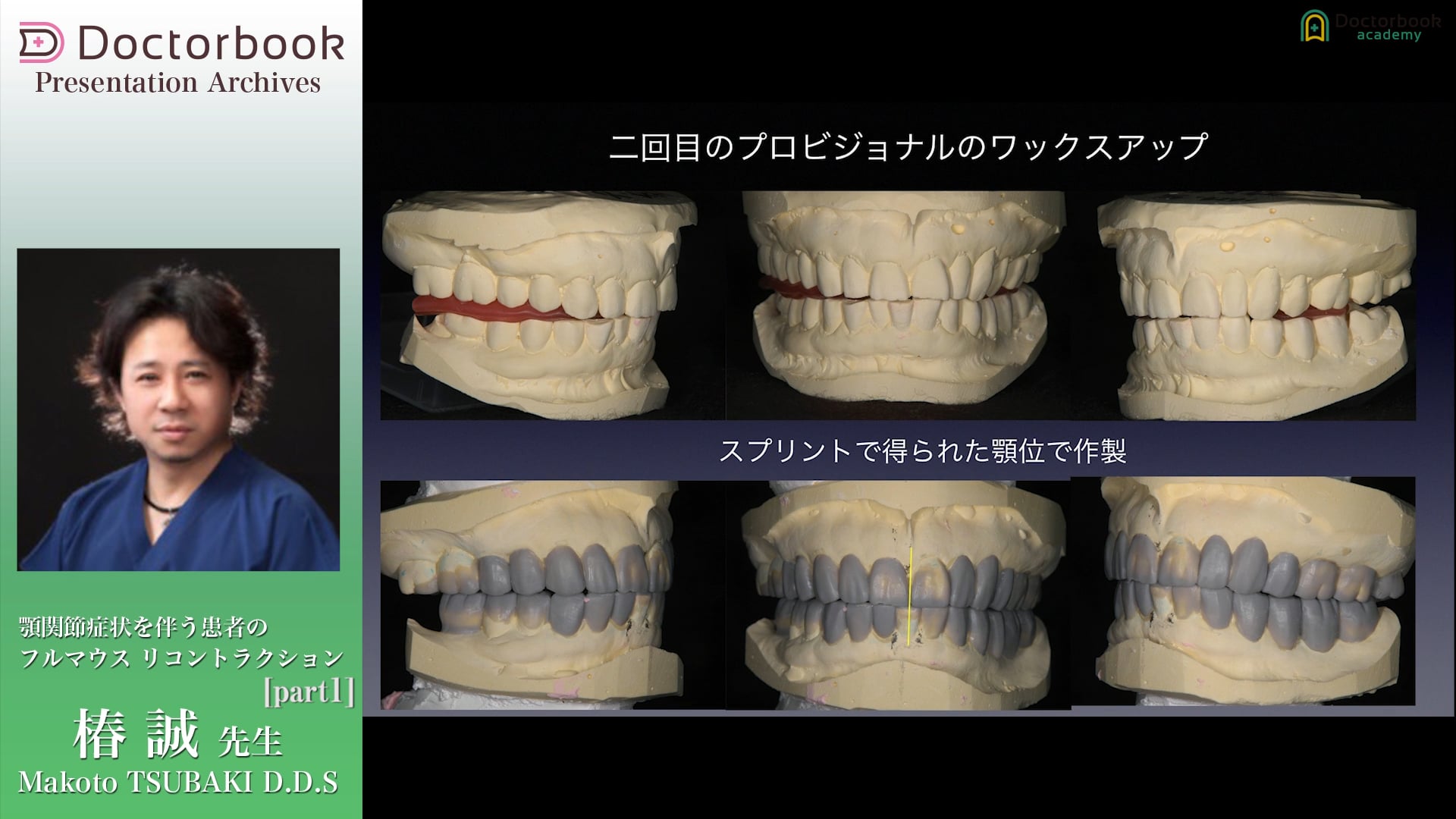 #1 顎位の変化によるプロビの調整