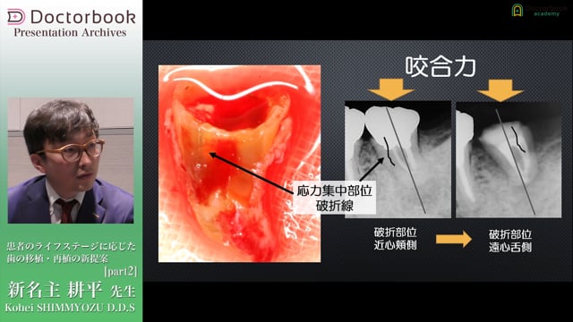 #2 歯根膜細胞を傷つけない抜歯のテクニック