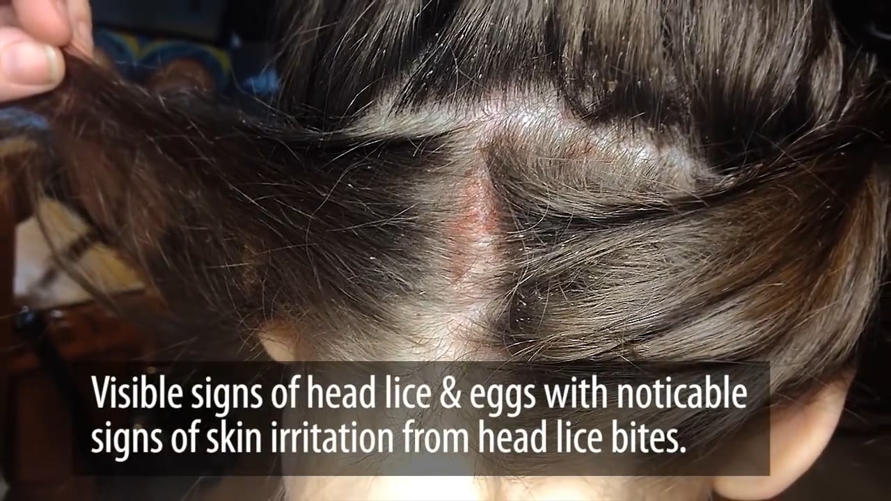 RESULTS! Licetec Head Lice Treatment Device on Vimeo