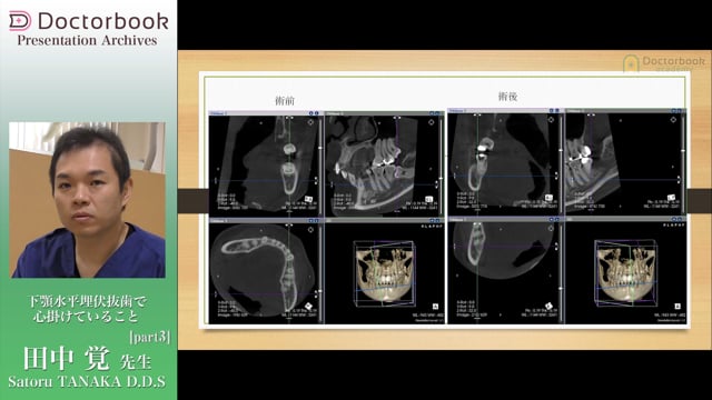 #3 下歯槽神経麻痺が出た場合