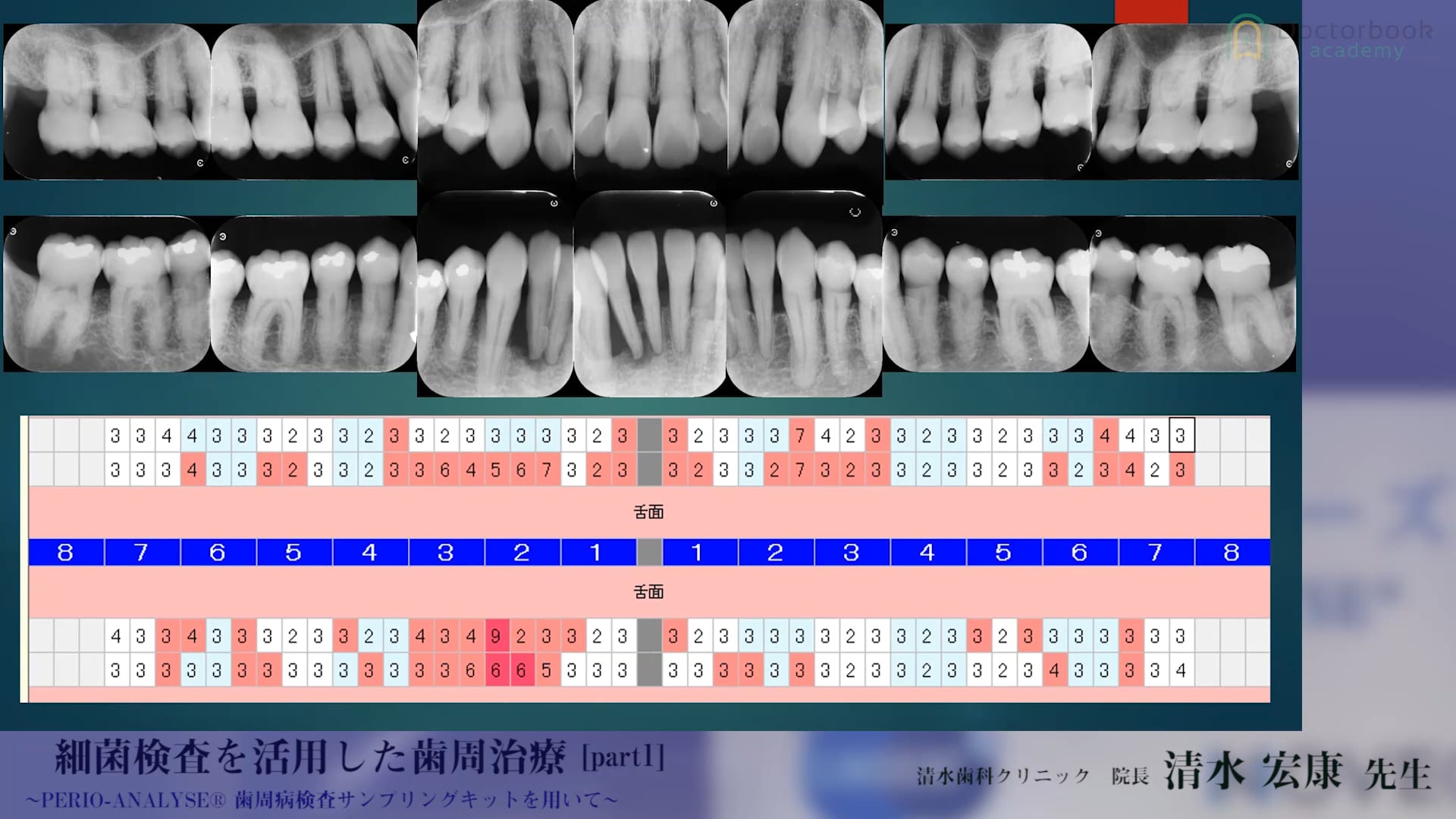 #1 健常者と歯周炎患者の細菌叢の違い