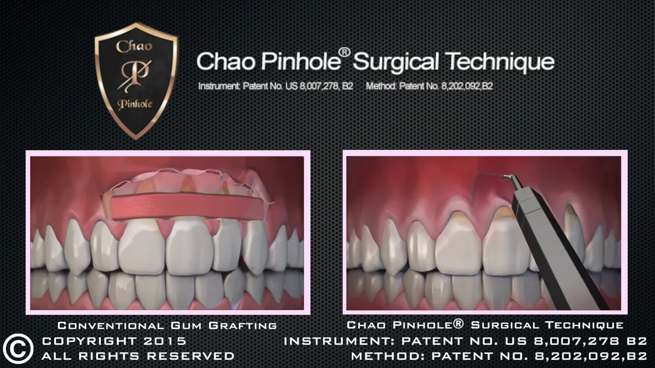 Cosmetic Smile Enhancement | Implant &amp; Laser Periodontal Surgery 
