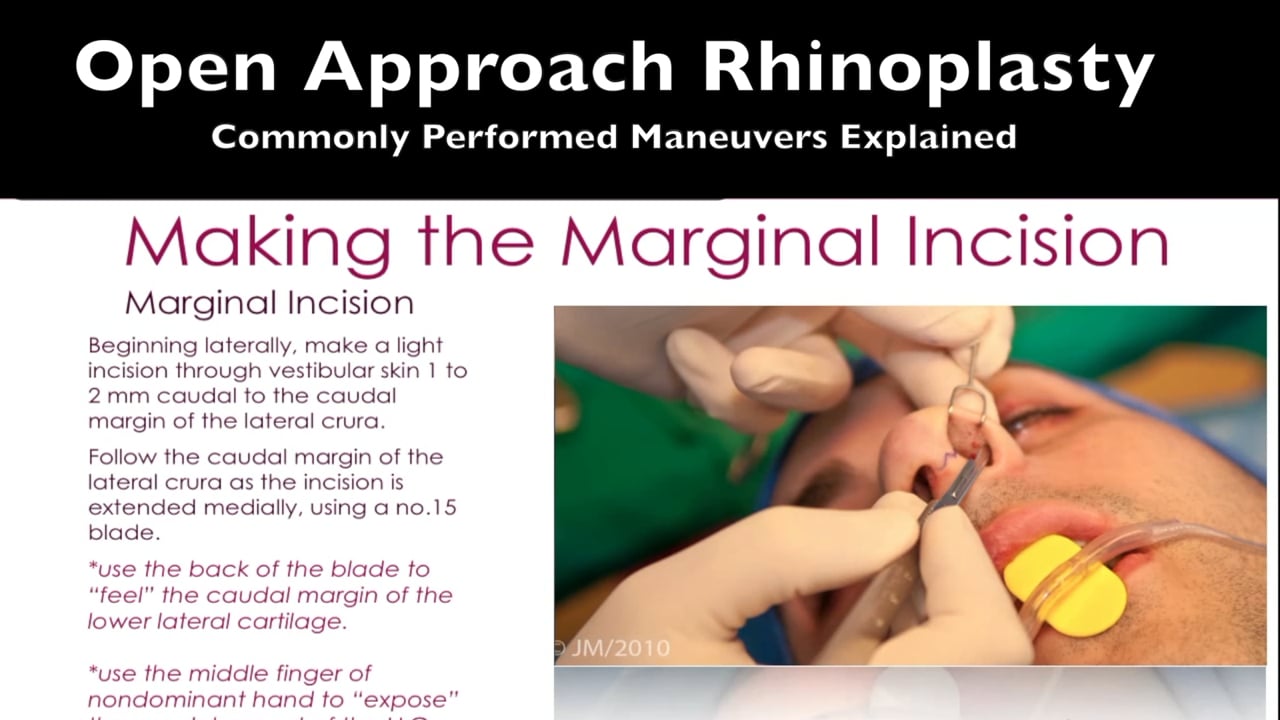 Rhinoplasty Open Approach Common Surgical Techniques