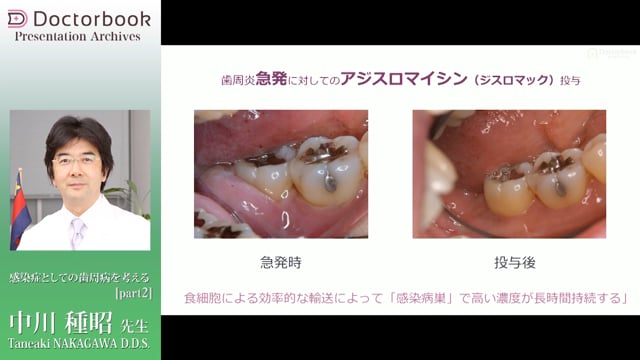 #2 SRPと抗菌薬の併用後の菌数の変化