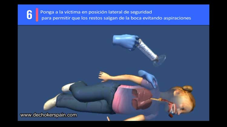 Instrucciones Dechoker, el dispositivo médico anti-atragantamiento on Vimeo