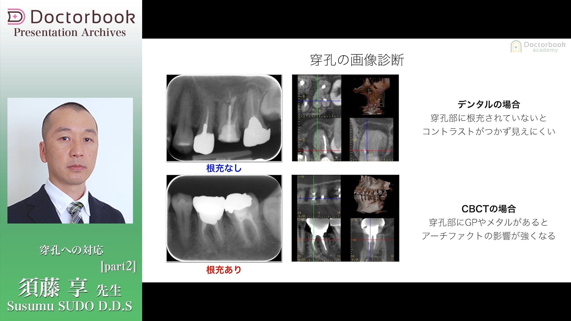 #2 穿孔の画像診断