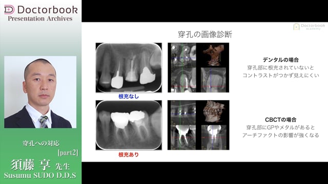 #2 穿孔の画像診断