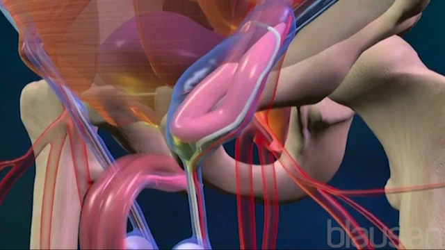 Medical Animation: Inguinal Hernia