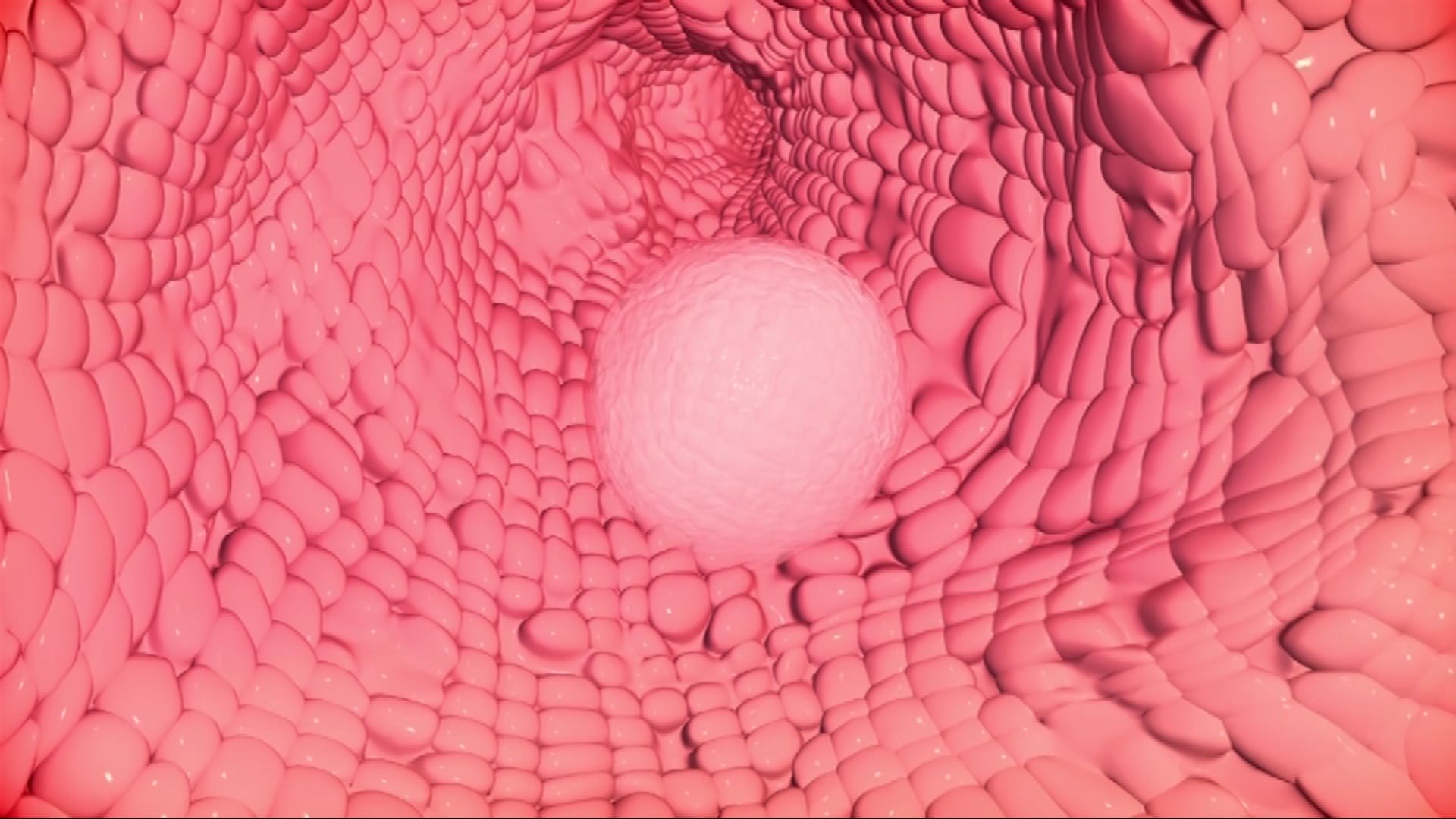 Renal cell carcinoma