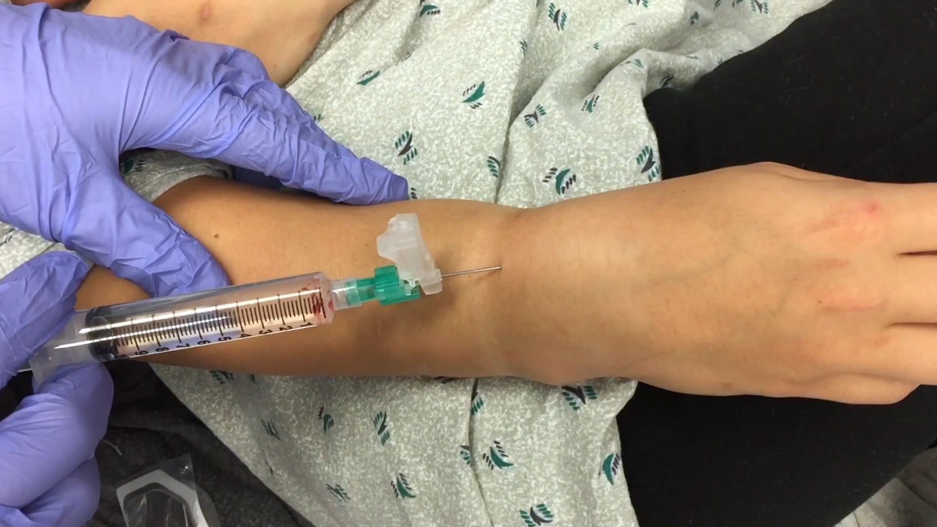 Closed reduction of distal radius fractures cosgrove on vimeo