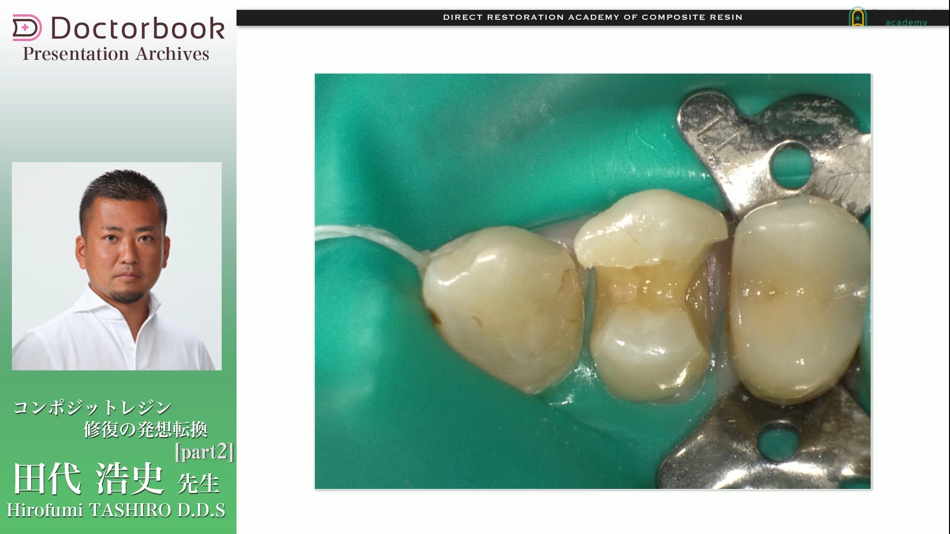 コンポジットレジン修復の発想転換 #2