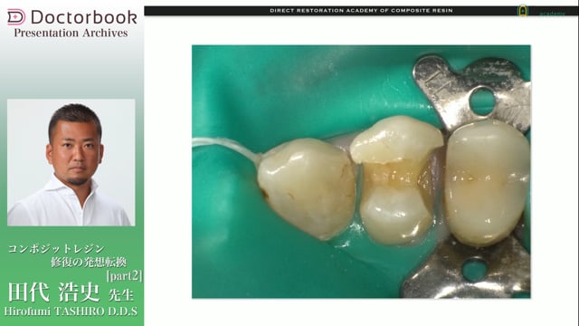 コンポジットレジン修復の発想転換 #2