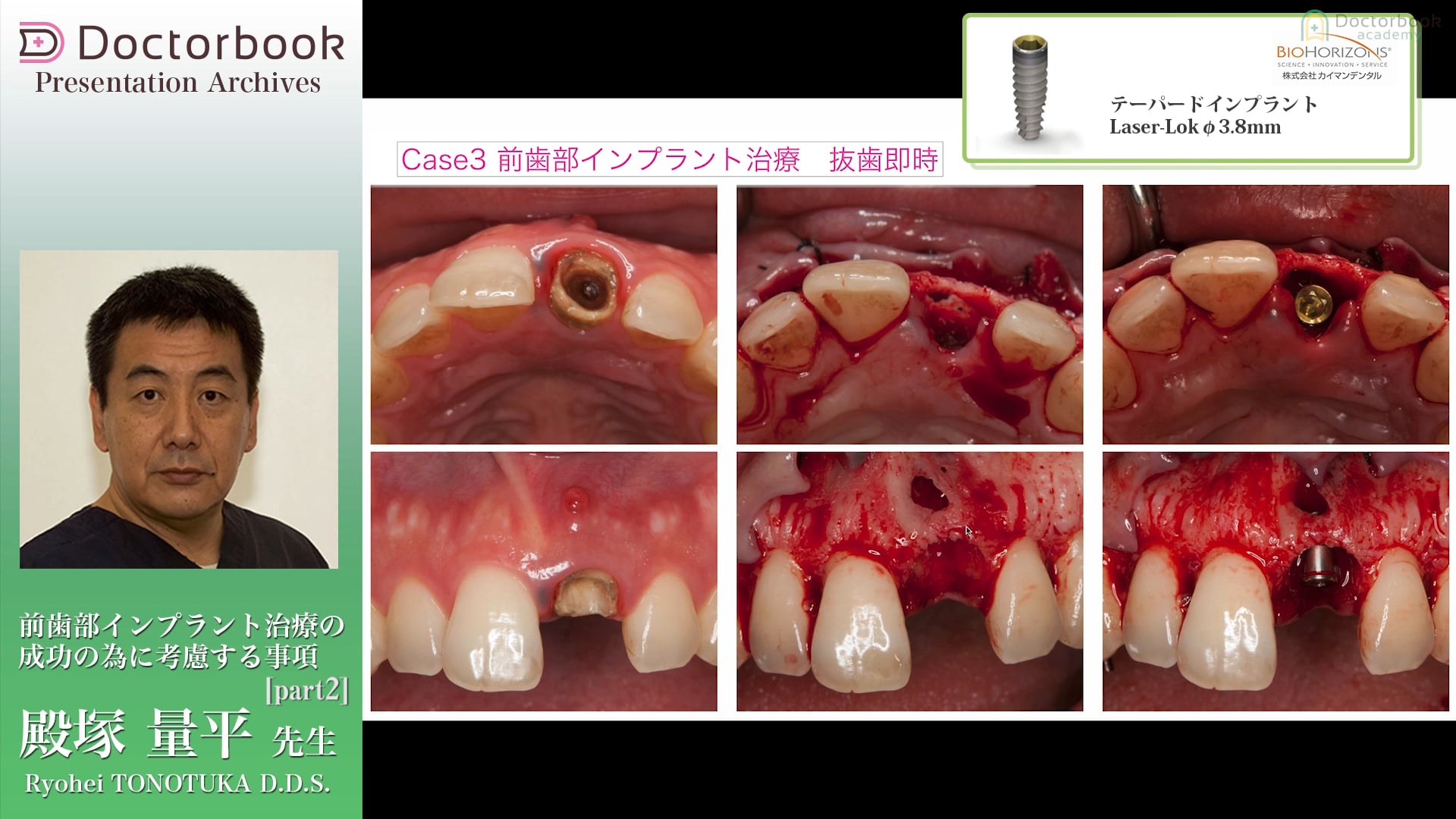 #2 抜歯即時埋入の利点欠点