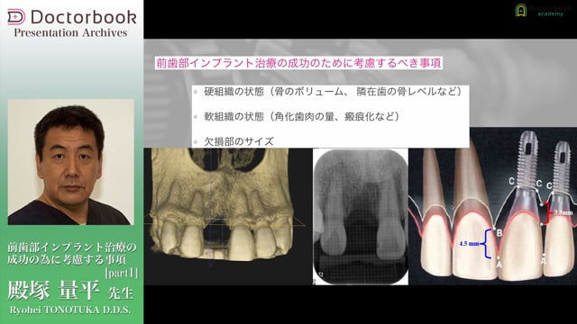 前歯部インプラント治療の成功の為に考慮する事項