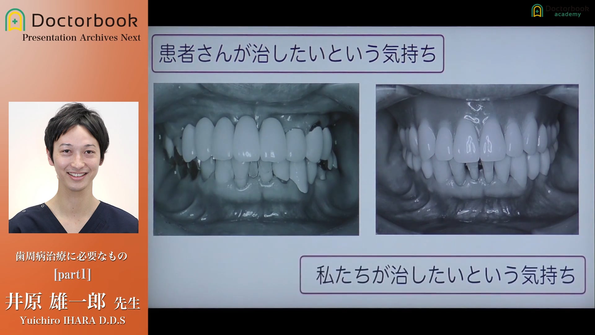 #1 歯周基本治療時の留意点