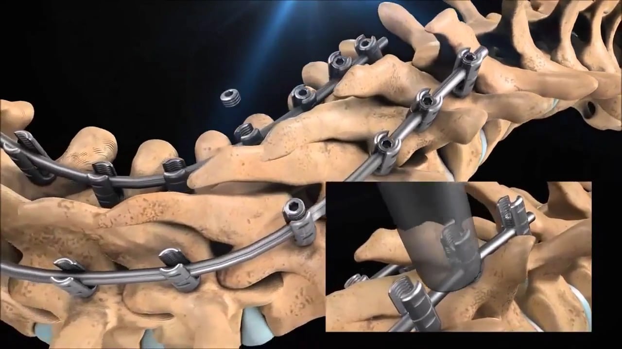 Bác sĩ phẫu thuật chữa cong vẹo cột sống qua mô phỏng 3D