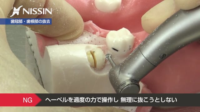 第2章 埋没抜歯の基本：抜歯の基本（水平埋伏歯）