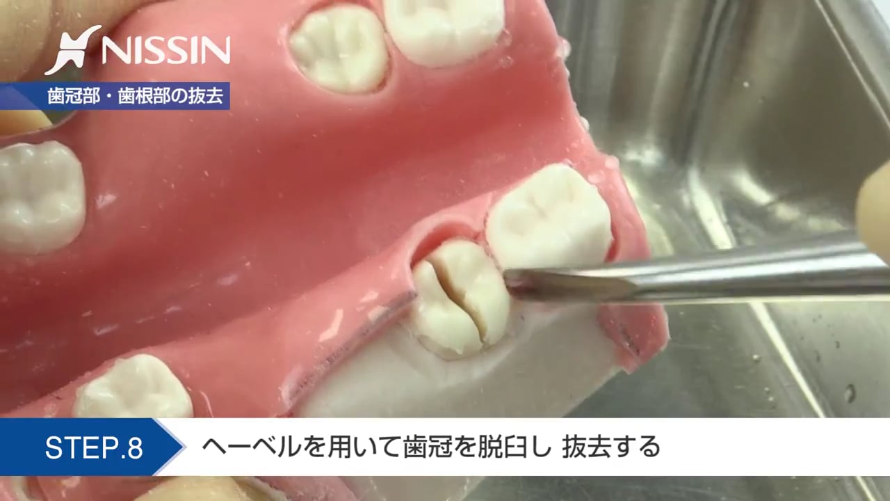 第2章 埋没抜歯の基本：抜歯の基本（半萌出歯） | Doctorbook