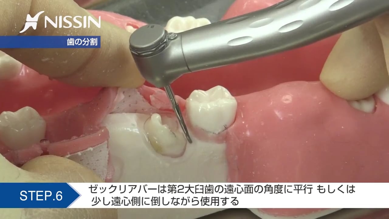 第2章 埋没抜歯の基本：抜歯の基本（近心傾斜歯）