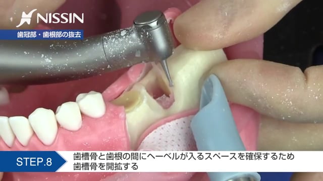 第3章 分割抜歯 埋伏歯抜歯の基本：抜歯の基本（水平埋伏歯の抜歯）