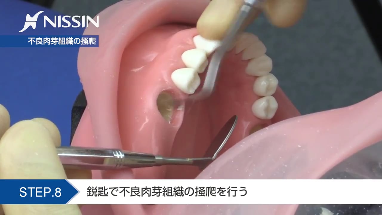 翻訳｜Vertical 2 骨造成 垂直的および水平的歯槽堤増大術の完成