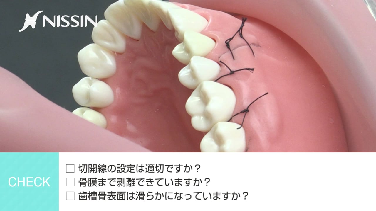 第4章 骨隆起の除去：骨隆起の除去の基本（上顎隆起除去）