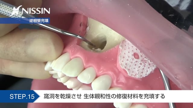 第5章 歯根端切除術の基本：歯根端切除術（上顎中切歯）