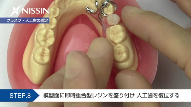 第7章 義歯の修理：クラスプ交換・増歯（歯の欠損に対する義歯の修理）
