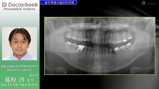 歯根完成歯の歯牙移植の位置付け ~臨床的考察と文献的考察~