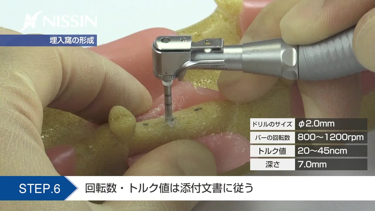 第11章 口腔インプラントの基本：ソケットリフト（上顎洞底拳上術）