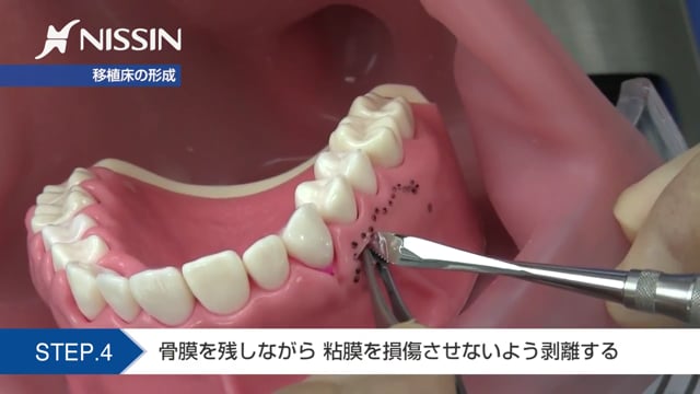 第8章 根分岐部病変の治療の基本：遊離歯肉移植術（Free Gingival Graft）