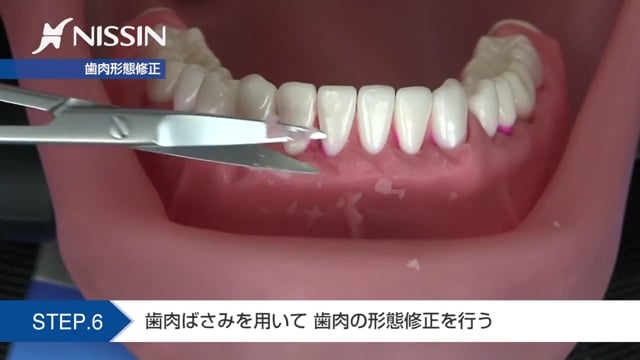 第9章 歯周外科の基本：歯肉切除術