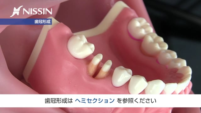 第11章 歯周外科の基本：ルートセパレーション