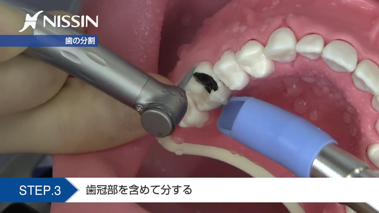 第11章 歯周外科の基本：トライセクション