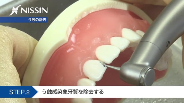 【MID-G GP】歯冠修復・歯内療法コース