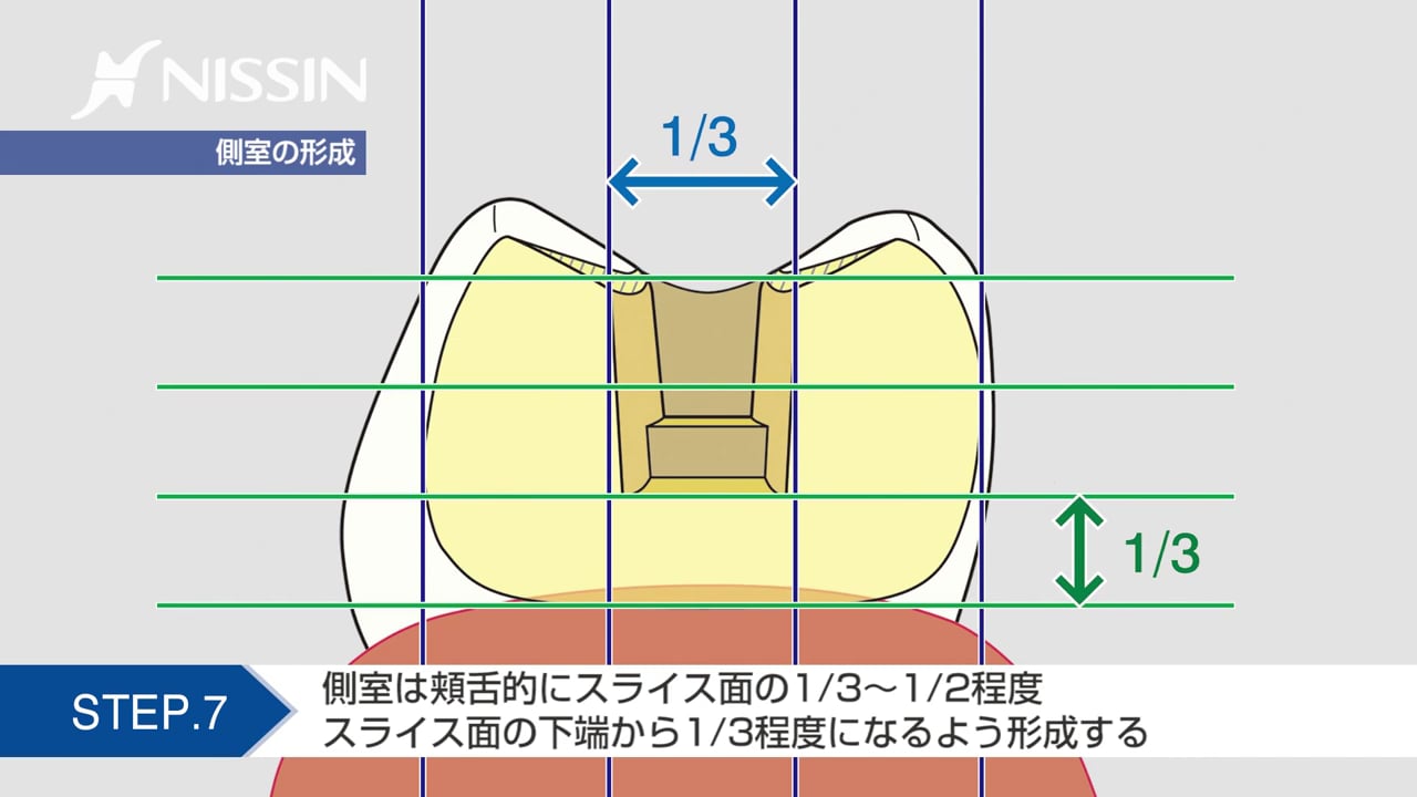 第3章 保険インレー窩洞形成 アンレー形成：2級MODインレー窩洞形成の基本（スライス式窩洞 下顎第2小臼歯）