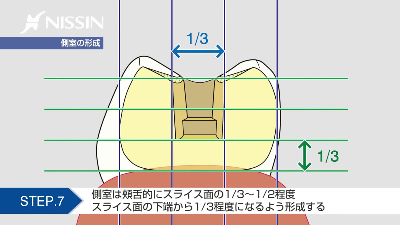 第4章 自費インレー窩洞形成 アンレー形成：2級MODゴールドインレー窩洞形成の基本（スライス式窩洞 下顎第1大臼歯）