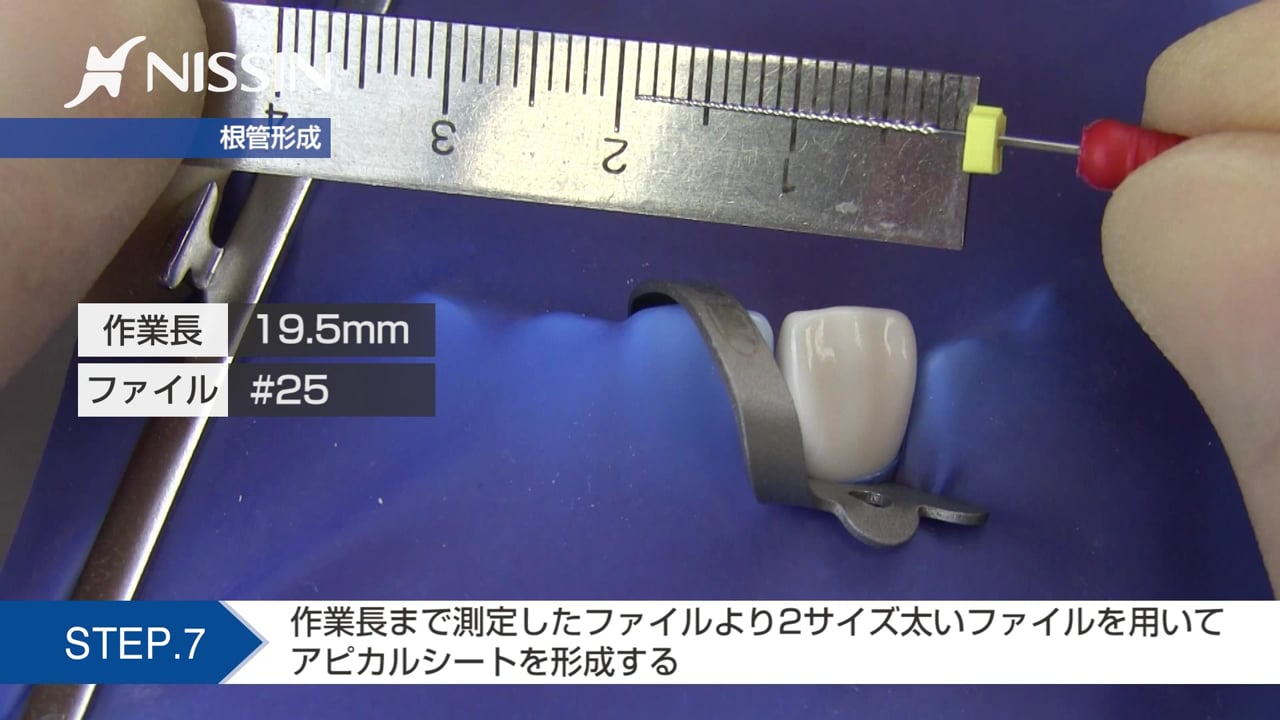 第10章 歯内療法修復：根管拡大・形成の基本（ステップバック法 上顎中切歯）