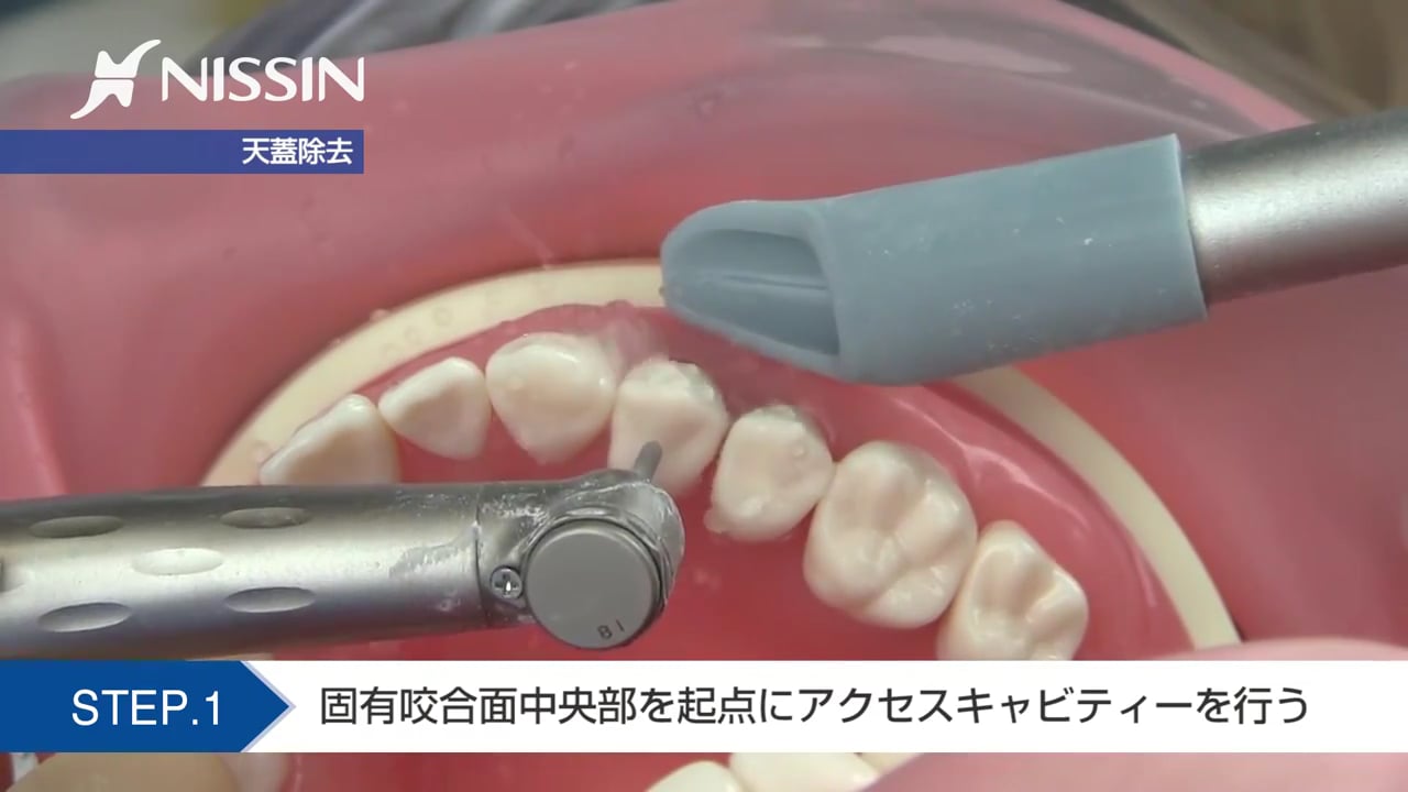 第10章 歯内療法修復：髄室開拡の基本（上顎第1小臼歯）