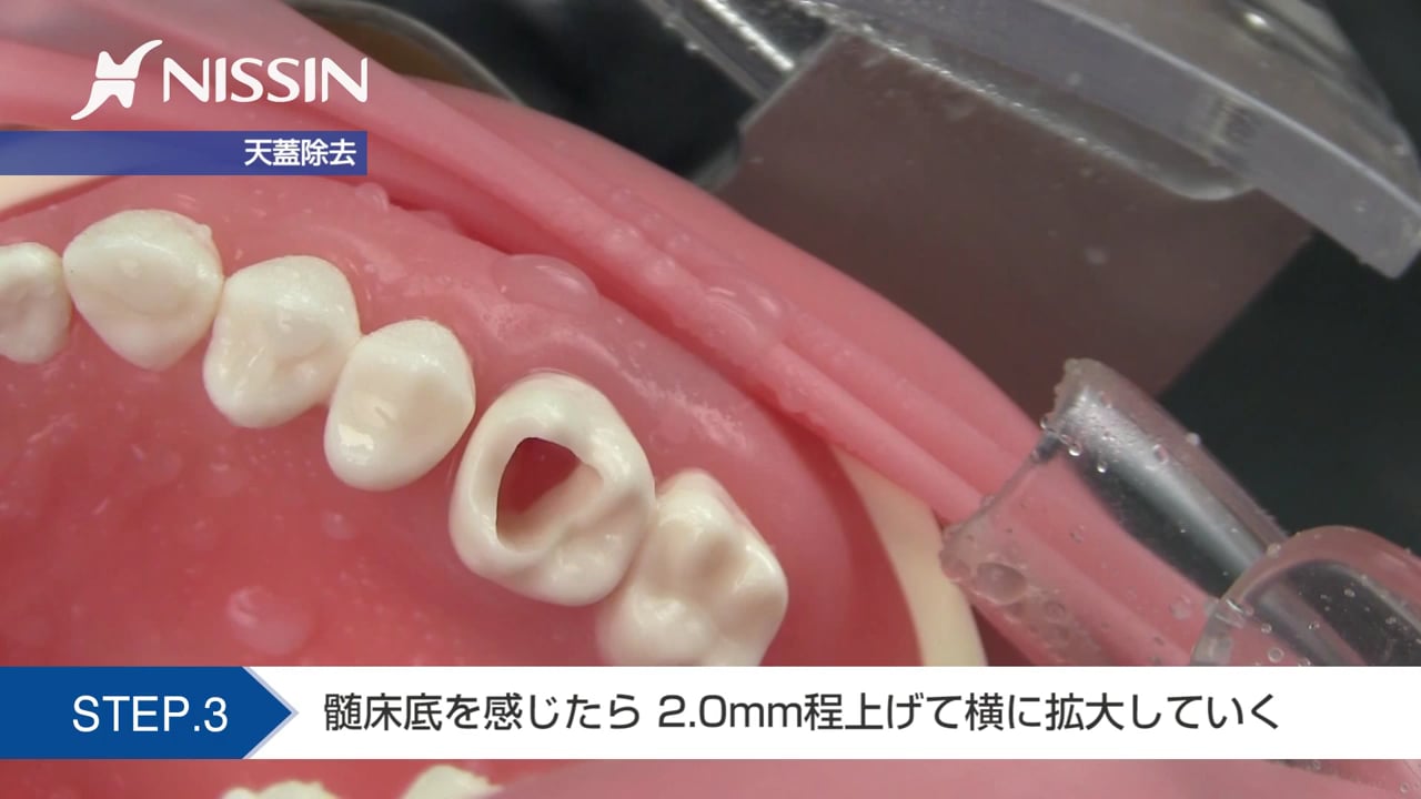 第10章 歯内療法修復：髄室開拡の基本（上顎第1大臼歯）